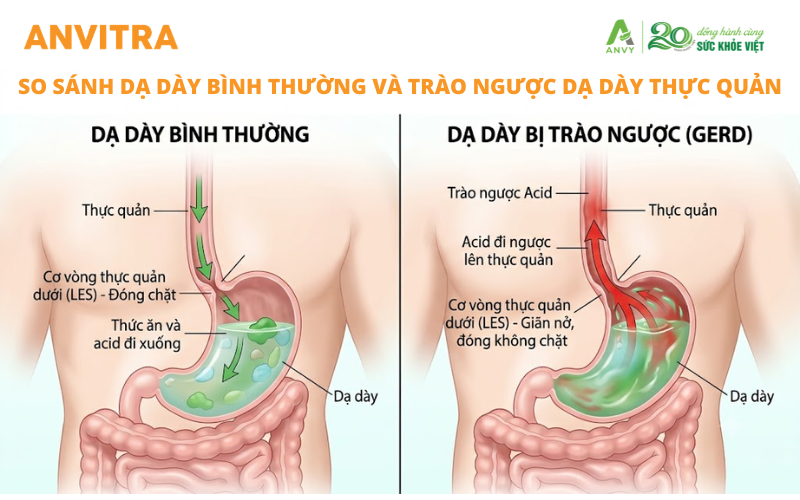 Ợ nóng kéo dài có thể liên quan đến trào ngược dạ dày