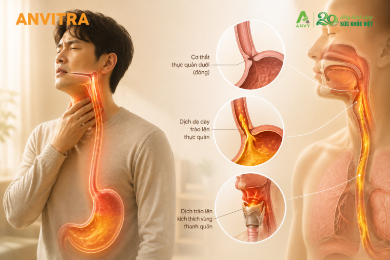 Trào ngược lên cao có thể gây kích ứng vùng họng và thanh quản