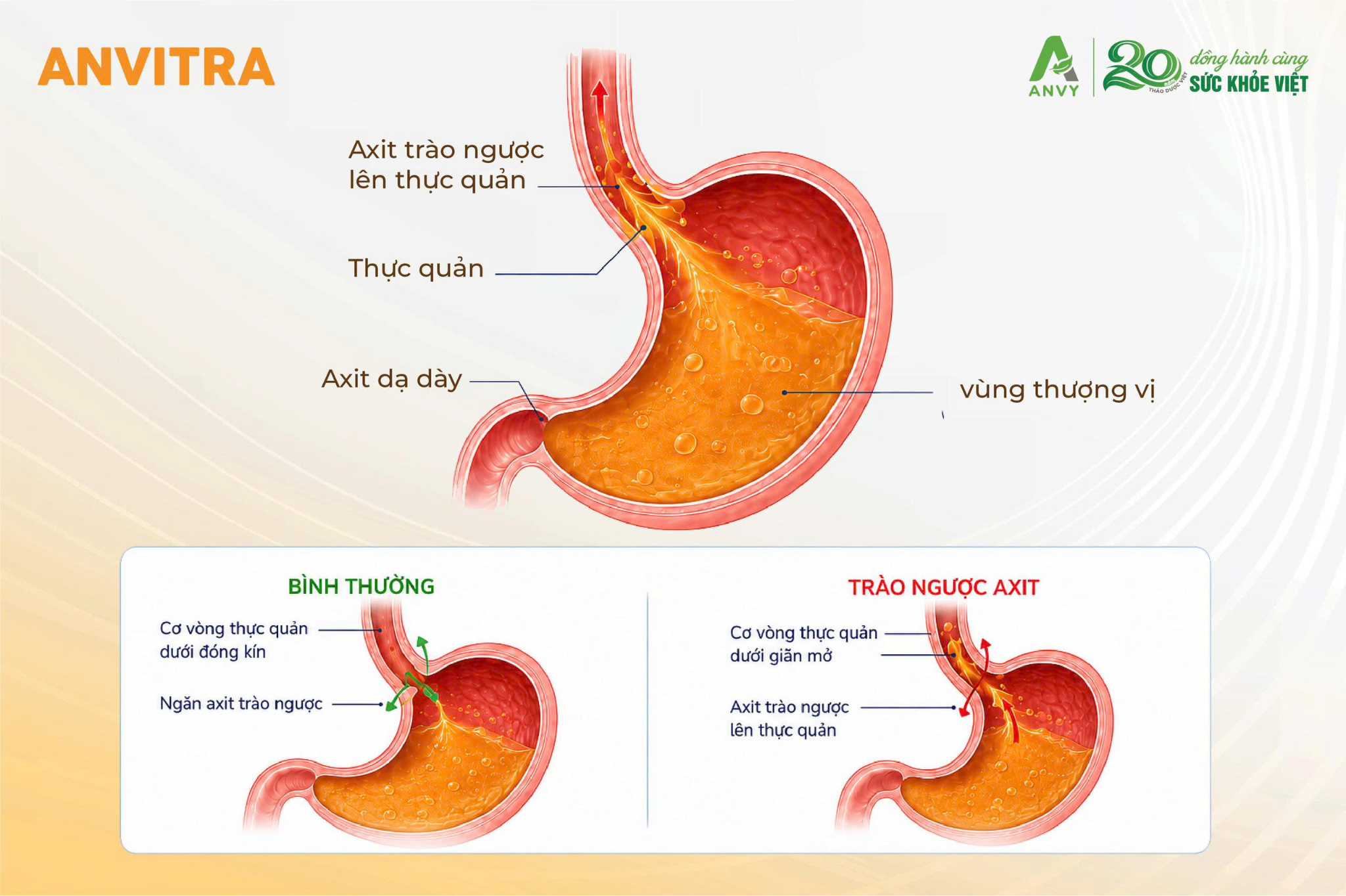 Triệu chứng đau bao tử thường gặp