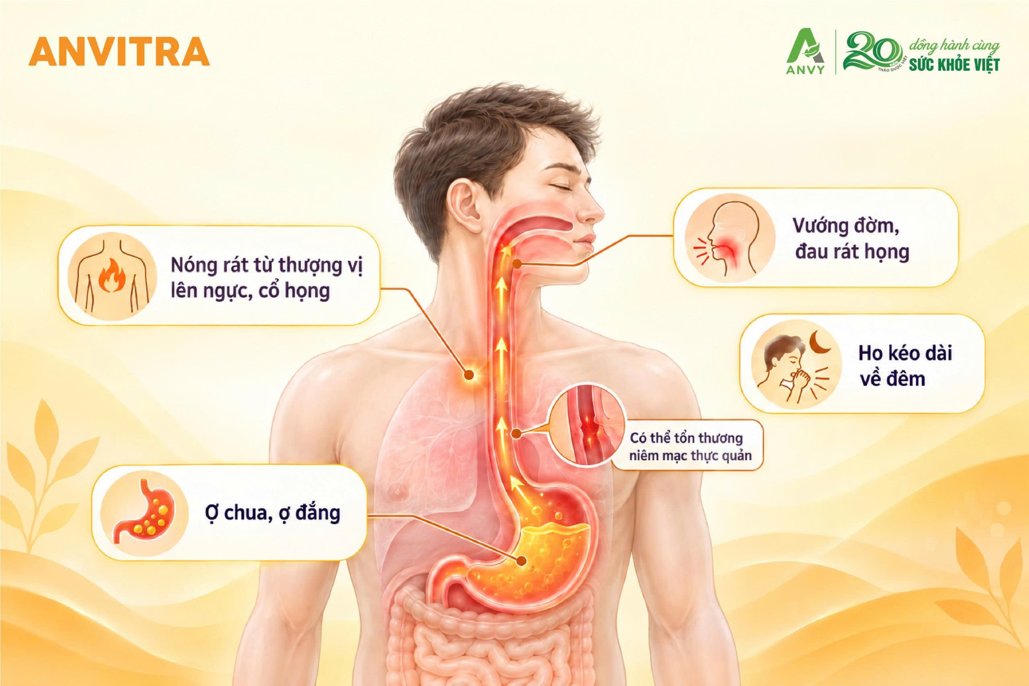 Các biểu hiện của trào ngược dạ dày thường gặp như nóng rát và ợ chua