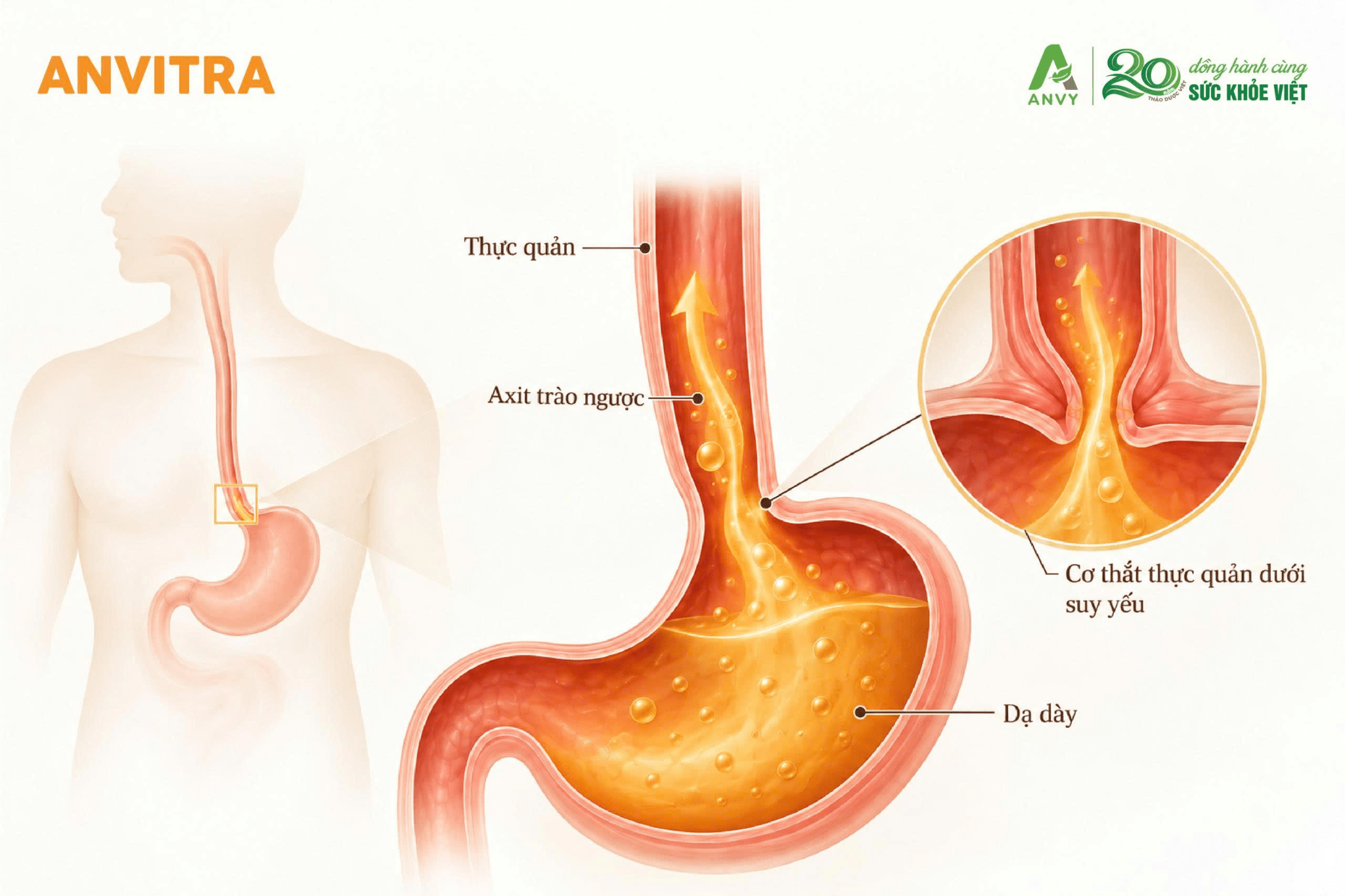 Cơ thắt thực quản dưới suy yếu là một trong những nguyên nhân gây trào ngược dạ dày thường gặp khiến ngực nóng rát.