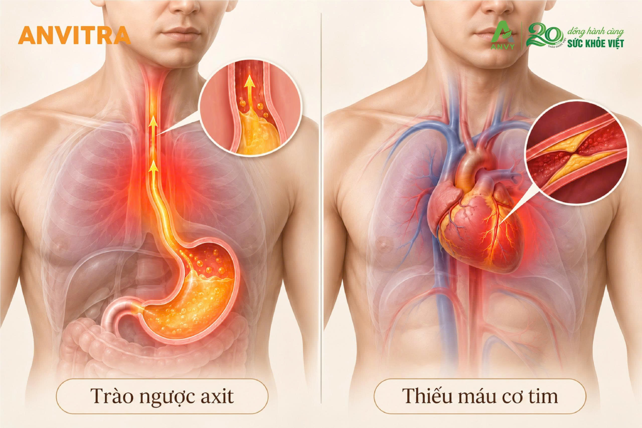 Nóng rát ngực chủ yếu do hiện tượng dạ dày trào ngược nhưng cũng có thể cảnh báo bệnh lý nguy hiểm.