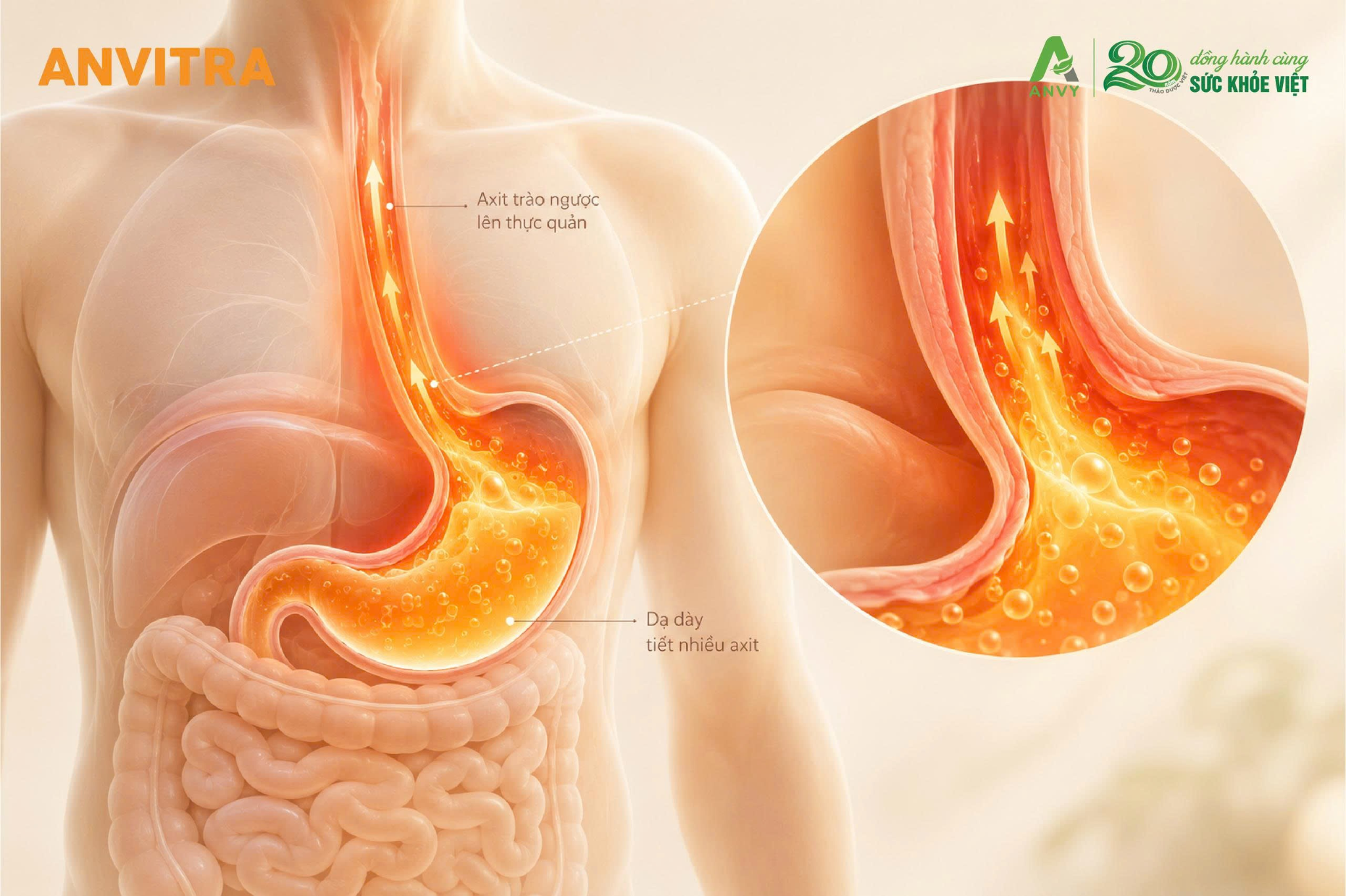 Axit dạ dày tiết quá mức gây bào mòn niêm mạc và hình thành các cơn nóng rát.