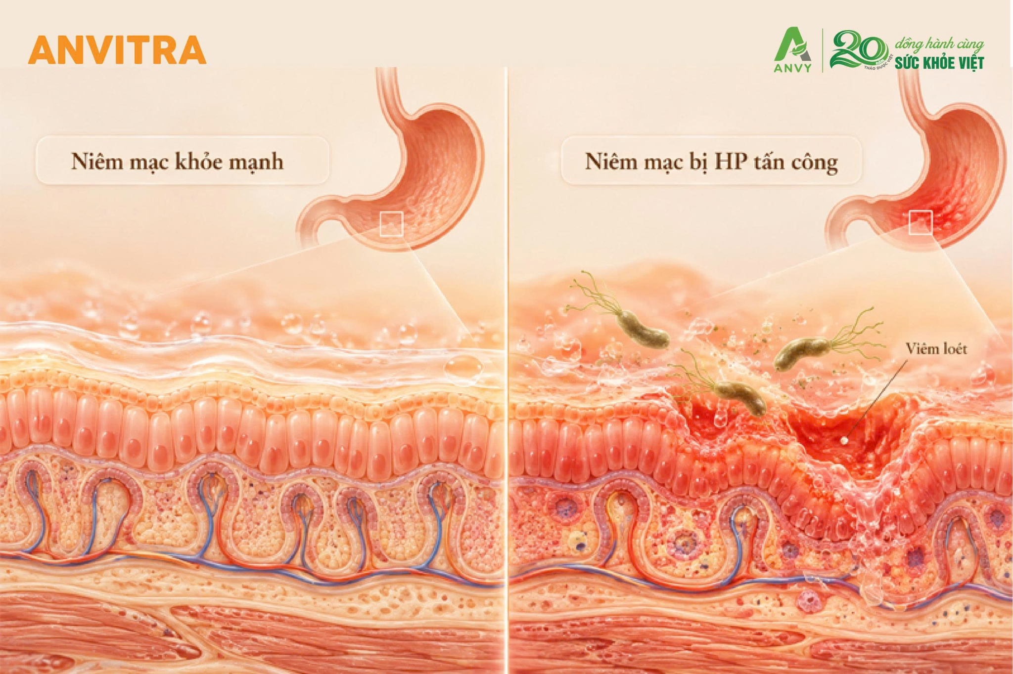 Vi khuẩn HP và việc lạm dụng thuốc NSAIDs là hai nguyên nhân hàng đầu gây viêm loét dạ dày.