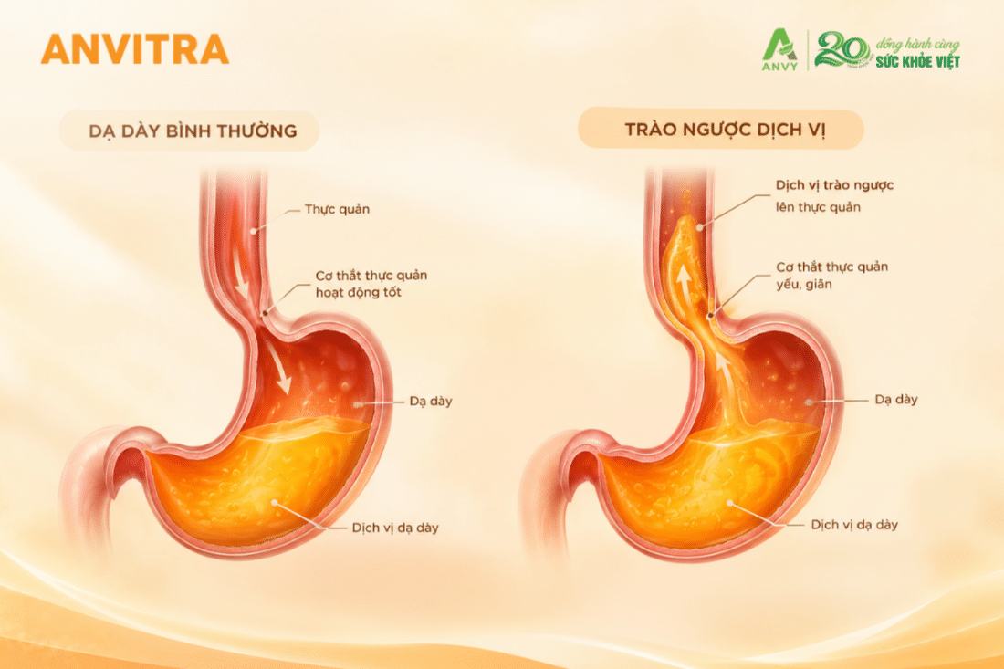 Cơ thắt thực quản dưới suy yếu khiến dịch vị dội ngược lên trên gây nóng rát cổ họng.